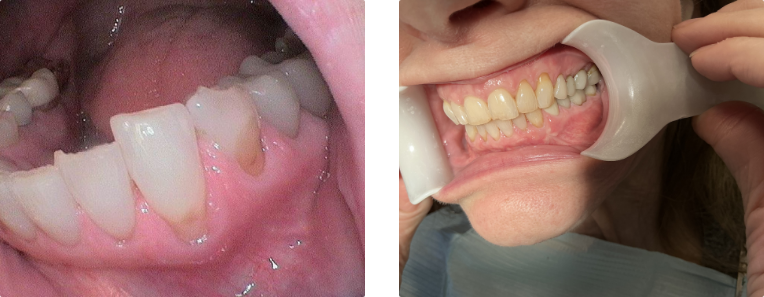 Close up of a mouth before and after correcting a yellowed front tooth