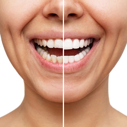 Nose-to-neck view of woman with smile divided to show before/after results with veneers