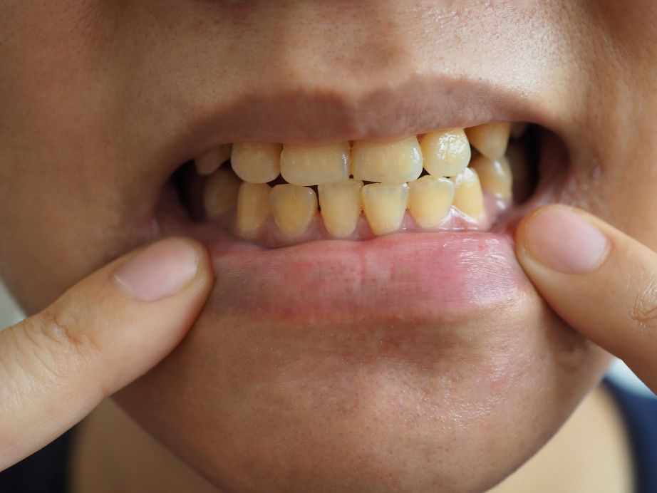 A man with yellow teeth